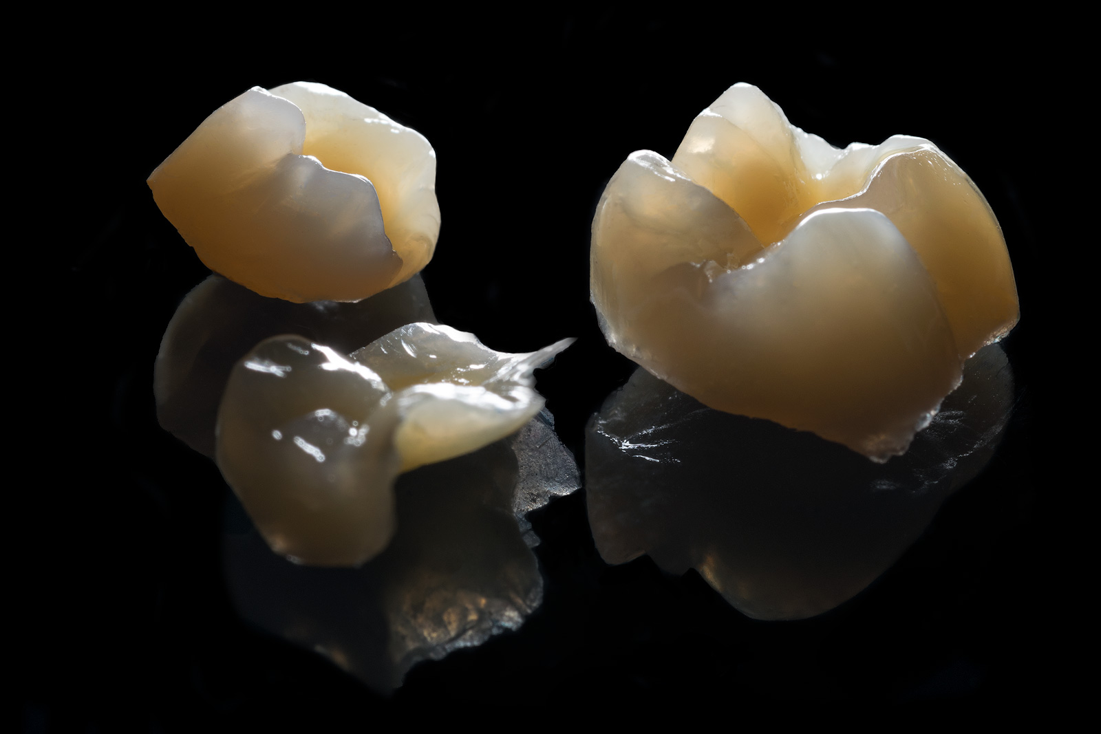 Onlays de composite
